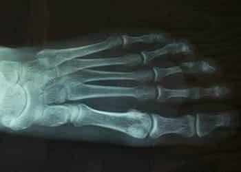 An x-ray of a foot.